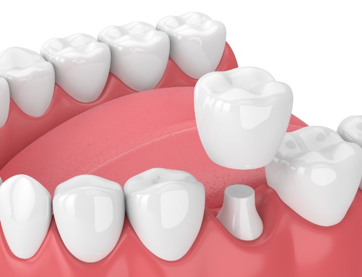 Idental crowns – benefits and possible downsides awxnews.com