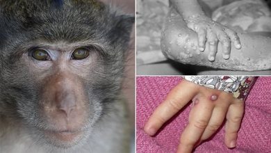 ما هو مرض جدري القرود ويكيبيديا