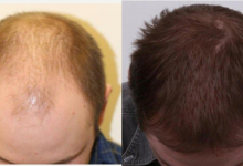 زراعة الشعر في السعودية