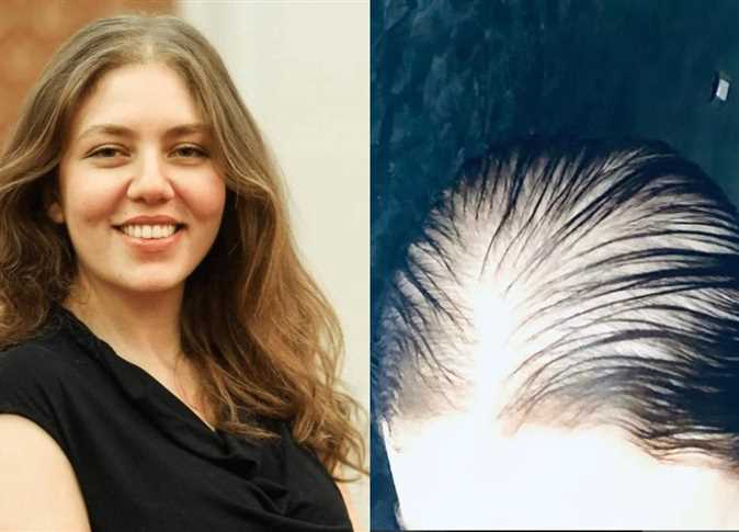 أزمة رحمة حسن وسبب فقدان شعرها